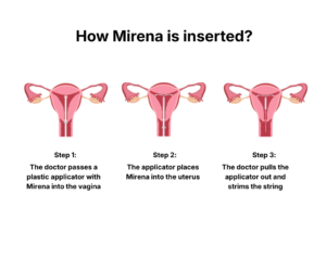 How Mirena is Inserted - You Drug Mart How Mirena is Inserted