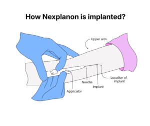 How Nexplanon is implanted - You Drug Mart How Nexplanon is implanted