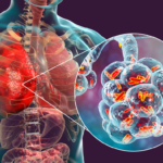 Legionnaires Disease, Symptoms, Outbreak and Prevention: What You Need to Know