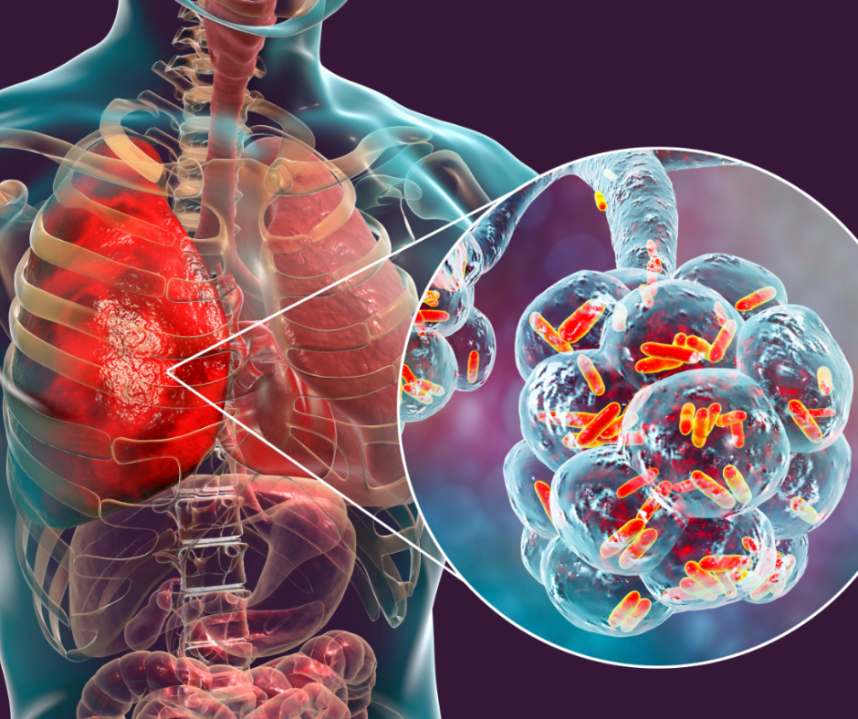 legionnaires disease
