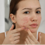 Topical Acne Medication – Compare the Best Products in the Market