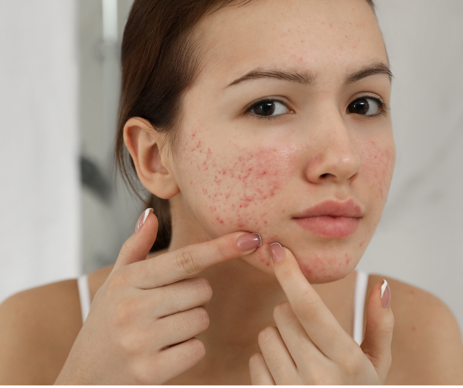 topical acne medication